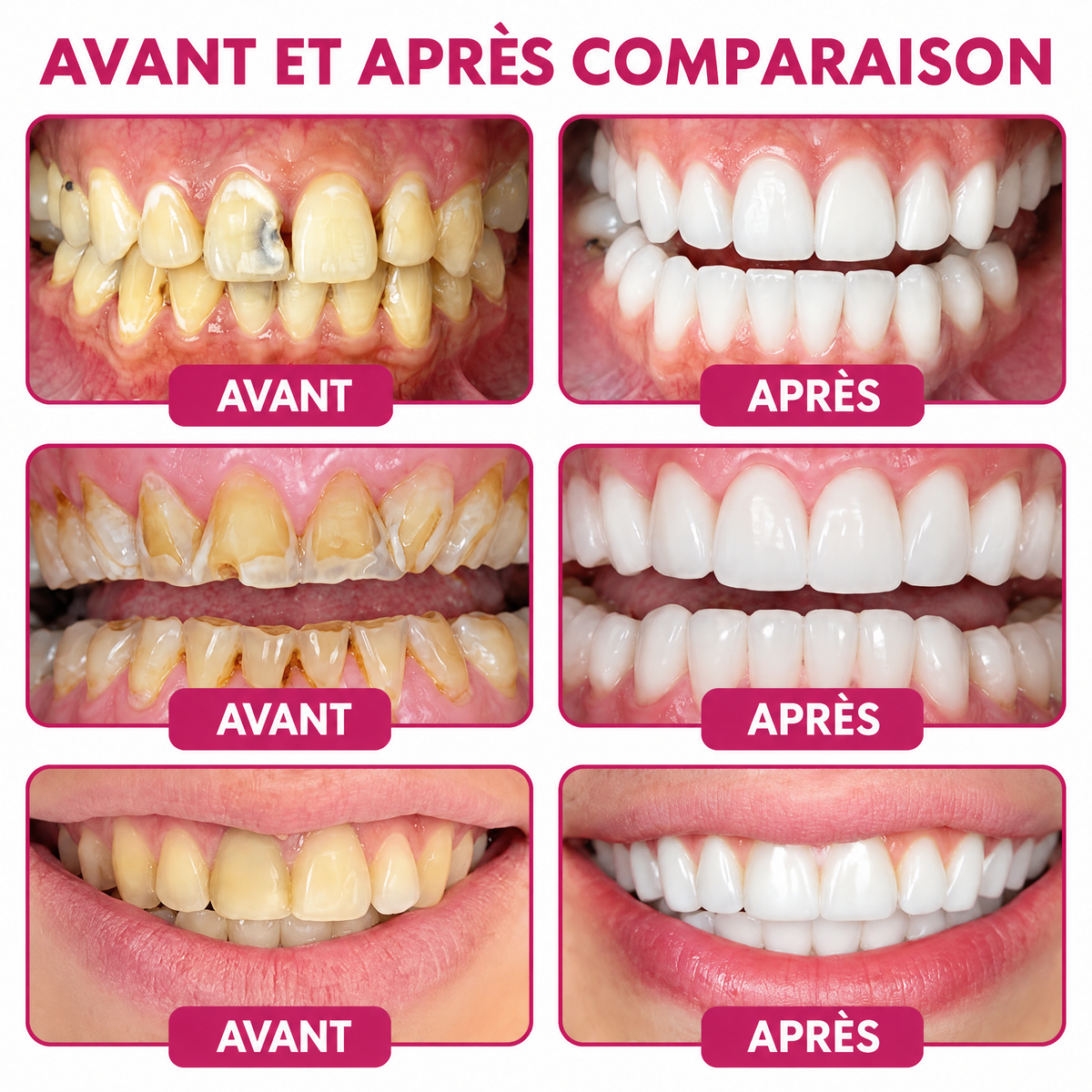 Cavity-Repair Natural Enamel Filling Gel