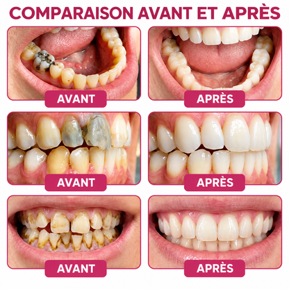 Cavity-Repair Natural Enamel Filling Gel